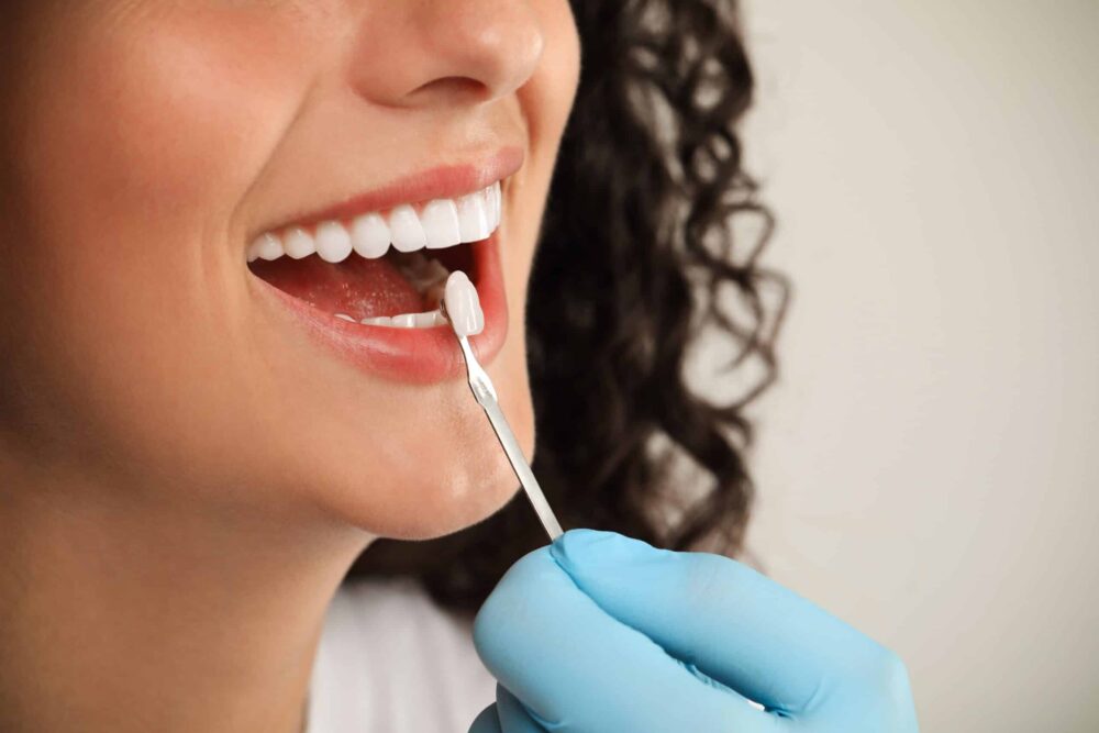 Dental Veneers in Beaver