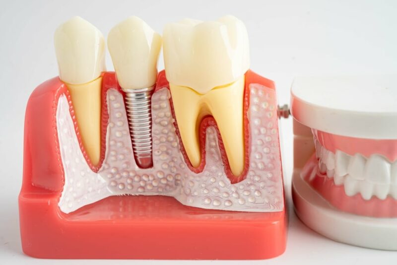 Dental Implants in Beaver
